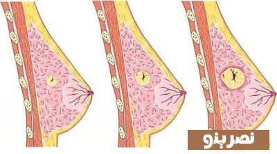 نشانه های کیست سینه