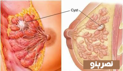 آشنایی با نشانه های کیست سینه