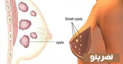 آشنایی با علائم کیست سینه