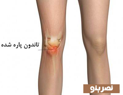 نحوه بیشگیری از صدای تاندون ها