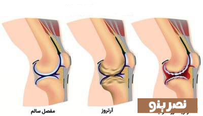 خطر ناک نبودن صدا دار بودن مفاصل