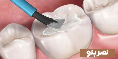 آشنایی با راه کار های رفع پوسیدگی دندان