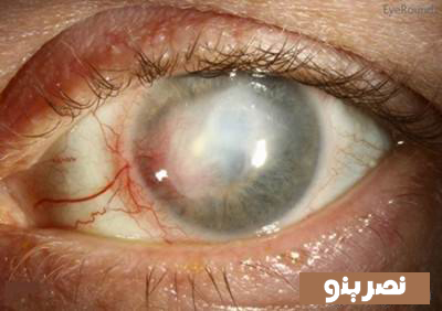 تبخال چشمی و علائم آن