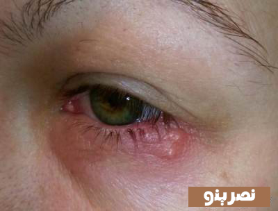 تبخال خارجی چشم 