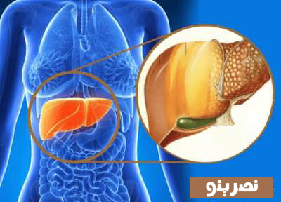 تشخیص کبد چرب