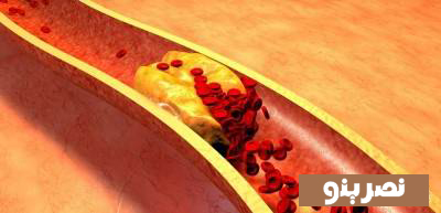 راه ای جلوگیری از سکته