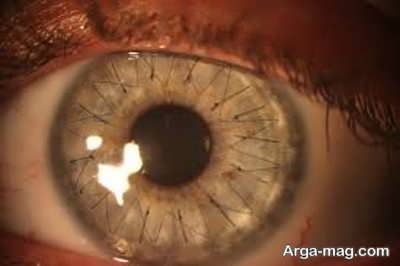 مراقبت های بعد از عمل پیوند قرنیه