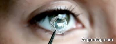 پیوند قرنیه چشم