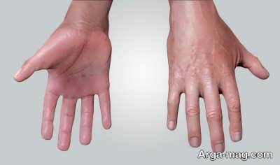 آیا عرق کردن کف دست، نشانه بیماری است؟