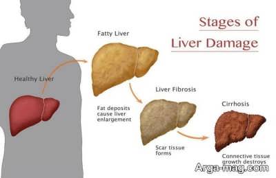 راه و روش درمان کبد چرب گرید 1