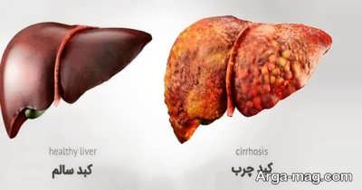 بیماری کبد چرب گرید 1 چیست؟