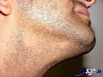 ریزش موی گلو سکه ای