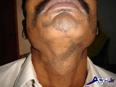 ریزش موی سکه ای