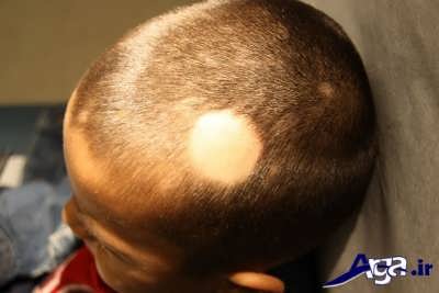 کچلی سکه ای