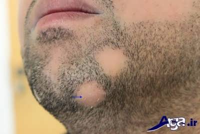 ریزش موی حاد سکه ای