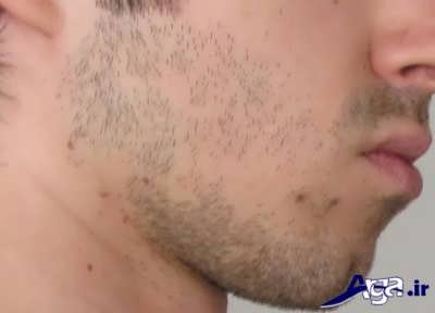 ریزش موی به صورت سکه ای