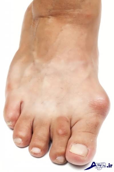 درمان های نقرس