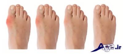 روش های درمانی نقرس