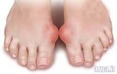 بیماری نقرس 