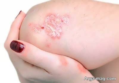 درمان سریع قارچ پوستی با روش های خانگی