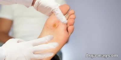 از بین بردن قارچ پوستی