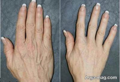 درمان خانگی وموثر چروک دست