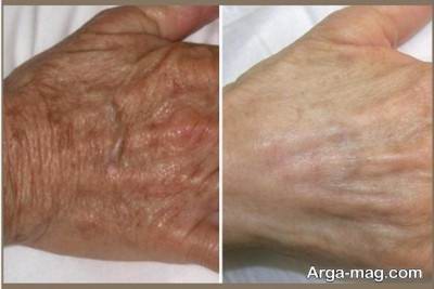 روش های جلوگیری از پیر پوست دست