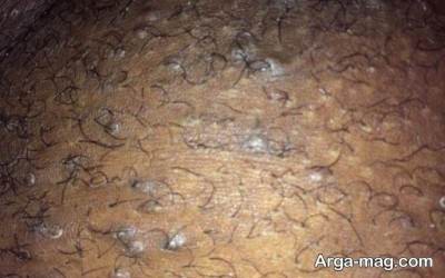 زگیل تناسلی و راه و روش های درمان خانگی آن