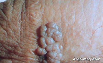 روش های درمان خانگی زگیل تناسلی