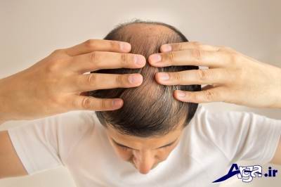 درمان ریزش مو با آب پیاز