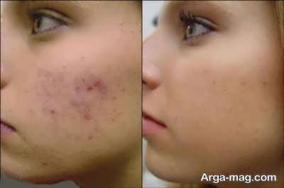 خواص گیاه مرزنجوش بر روی پوست