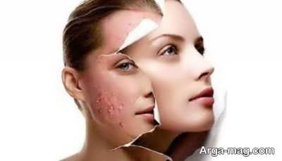 جلوگیری از آکنه