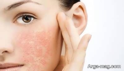 برطرف کردن خشکی پوست