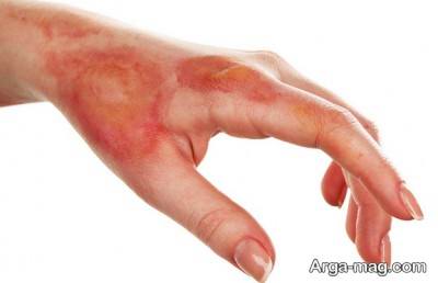 بهبود مشکلات پوستی ناشی از سوختگی