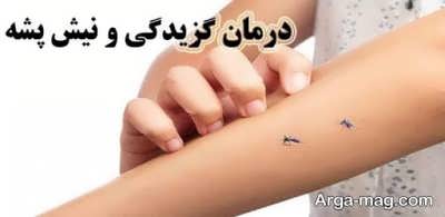 درمان نیش پشه