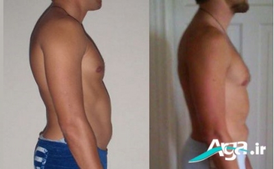 درمان گودی کمر