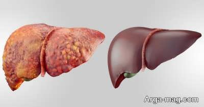 درمان خانگی و طبیعی کبد چرب با خاکشیر