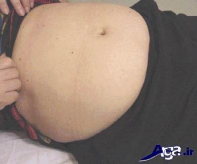 درمان نفخ شکم