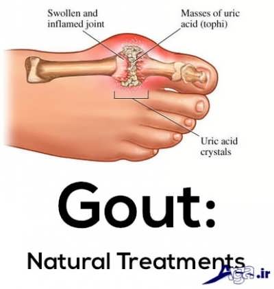 درمان بیماری نقرس
