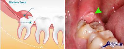 جراحی دندان عقل