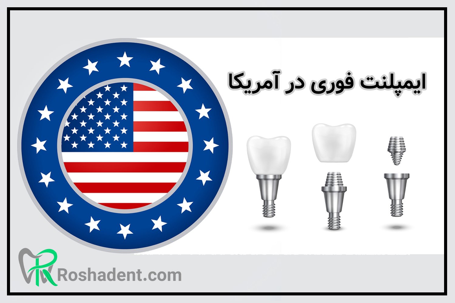 ایمپلنت فوری در آمریکا