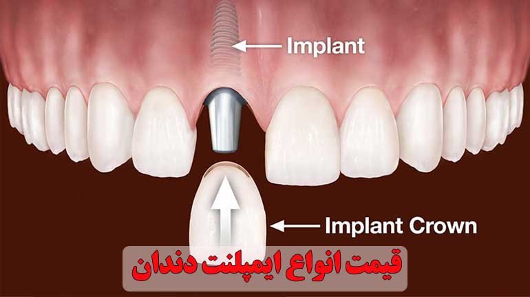 هزینه ایمپلنت دندان 1402